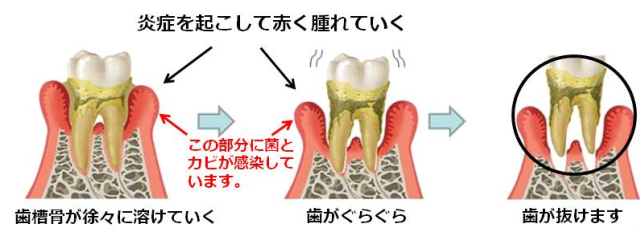 歯周病の経過