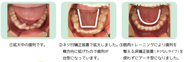 床矯正装置を使って歯列を整えました