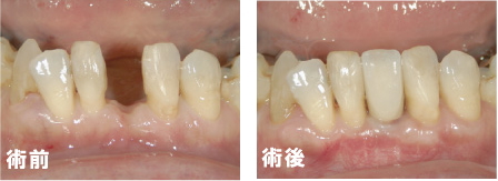 インプラント治療の前と後