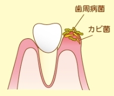 カビが歯ぐきについて根を下ろし炎症を起こします