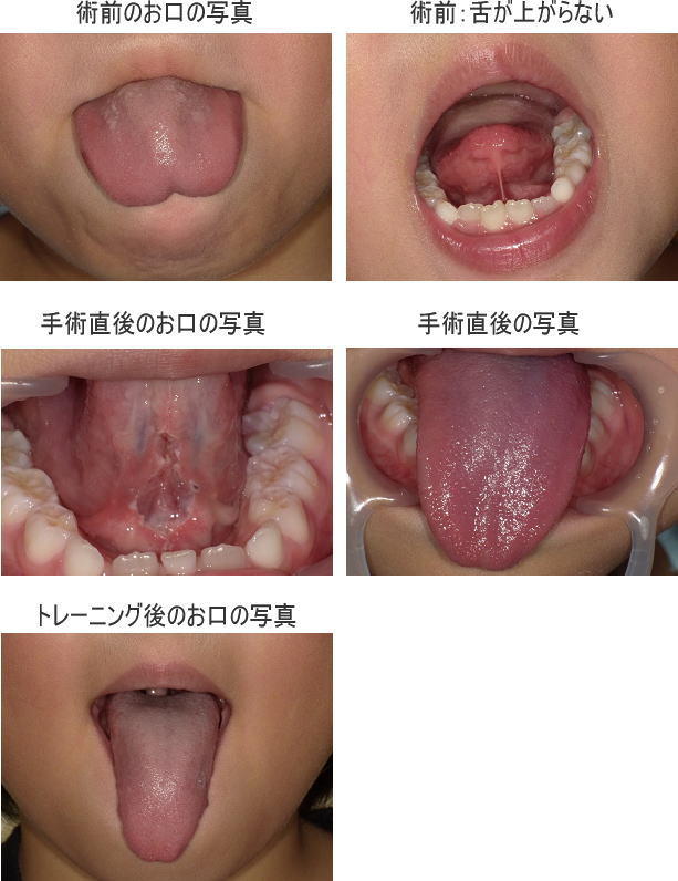 伸びる のどちんこ 口蓋垂が伸びる症状